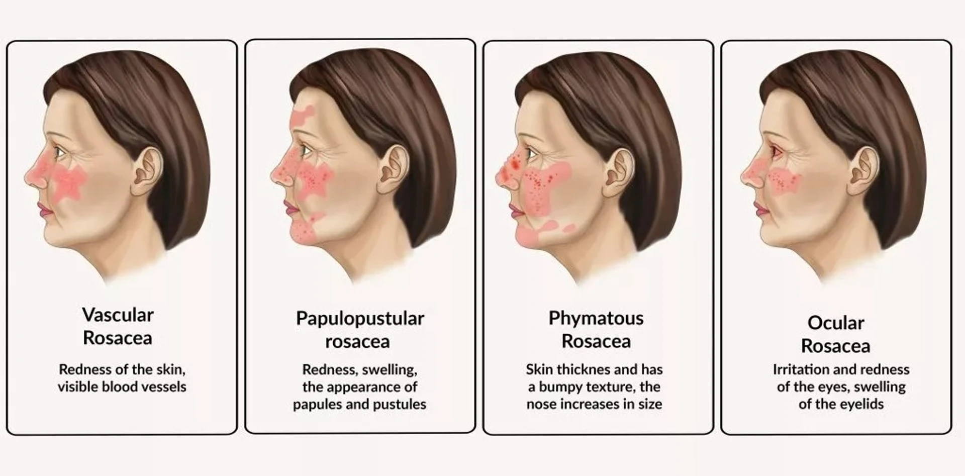 Rozase ve tetikleyicileri: detaylı bir rehber