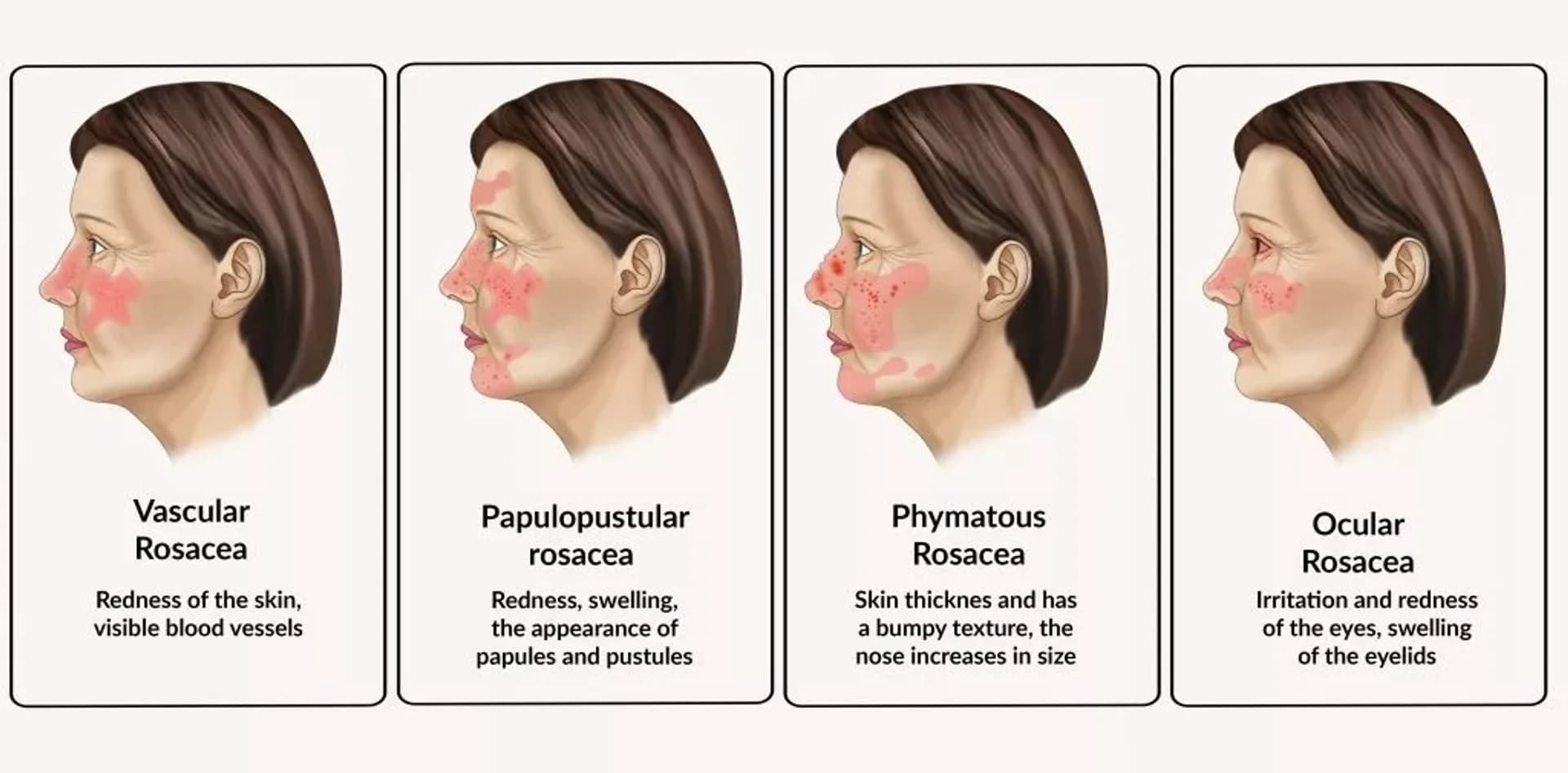 Rozase ve tetikleyicileri: detaylı bir rehber