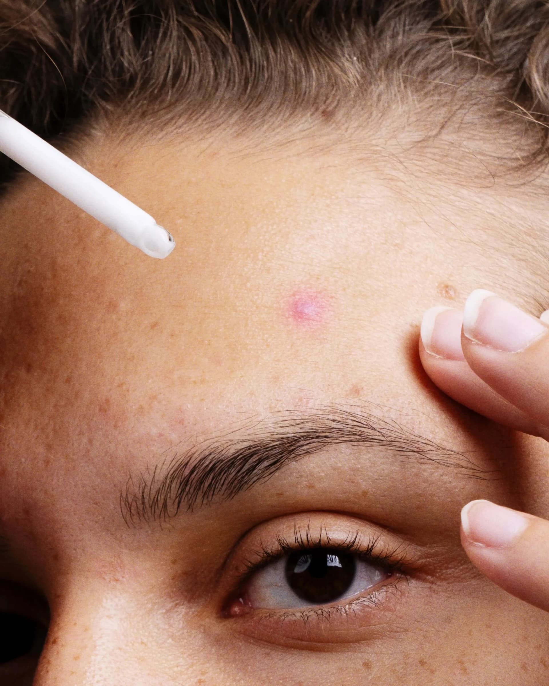 Niasinamid akneye karşı yardımcı olur mu?