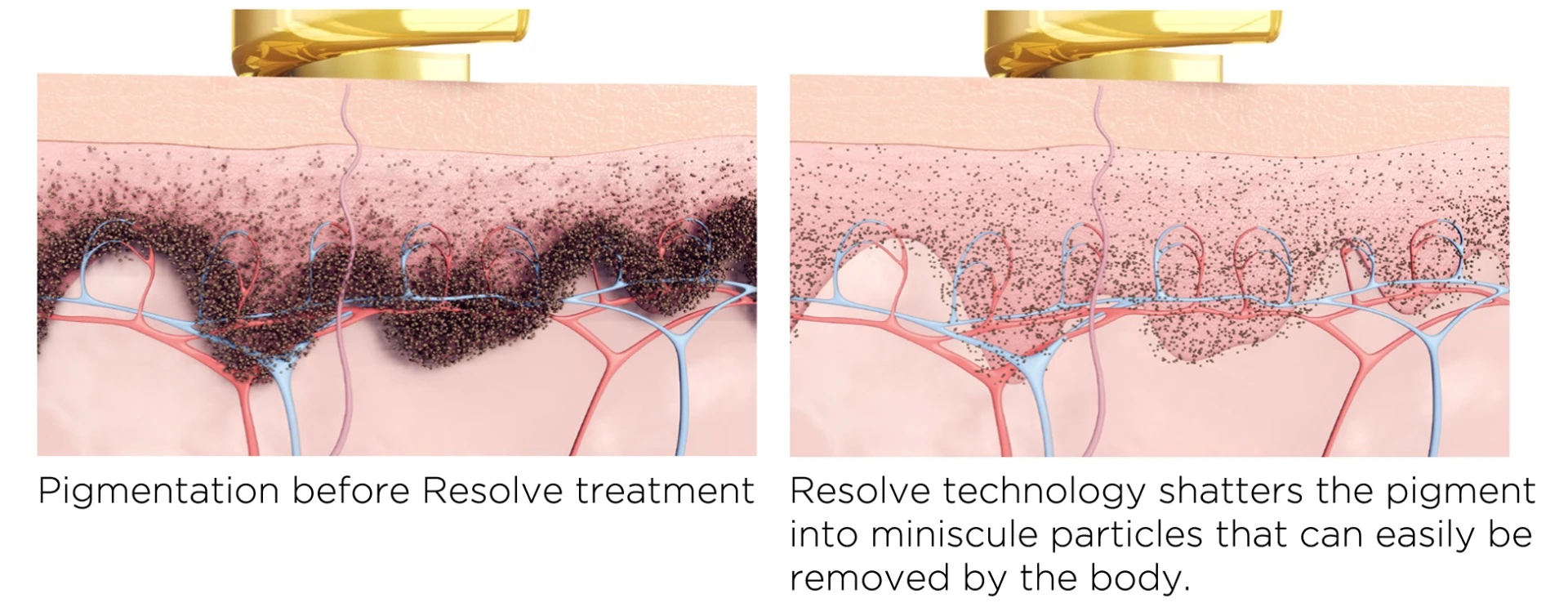 Ellerdeki yaşlılık lekeleri nasıl tedavi edilir?
