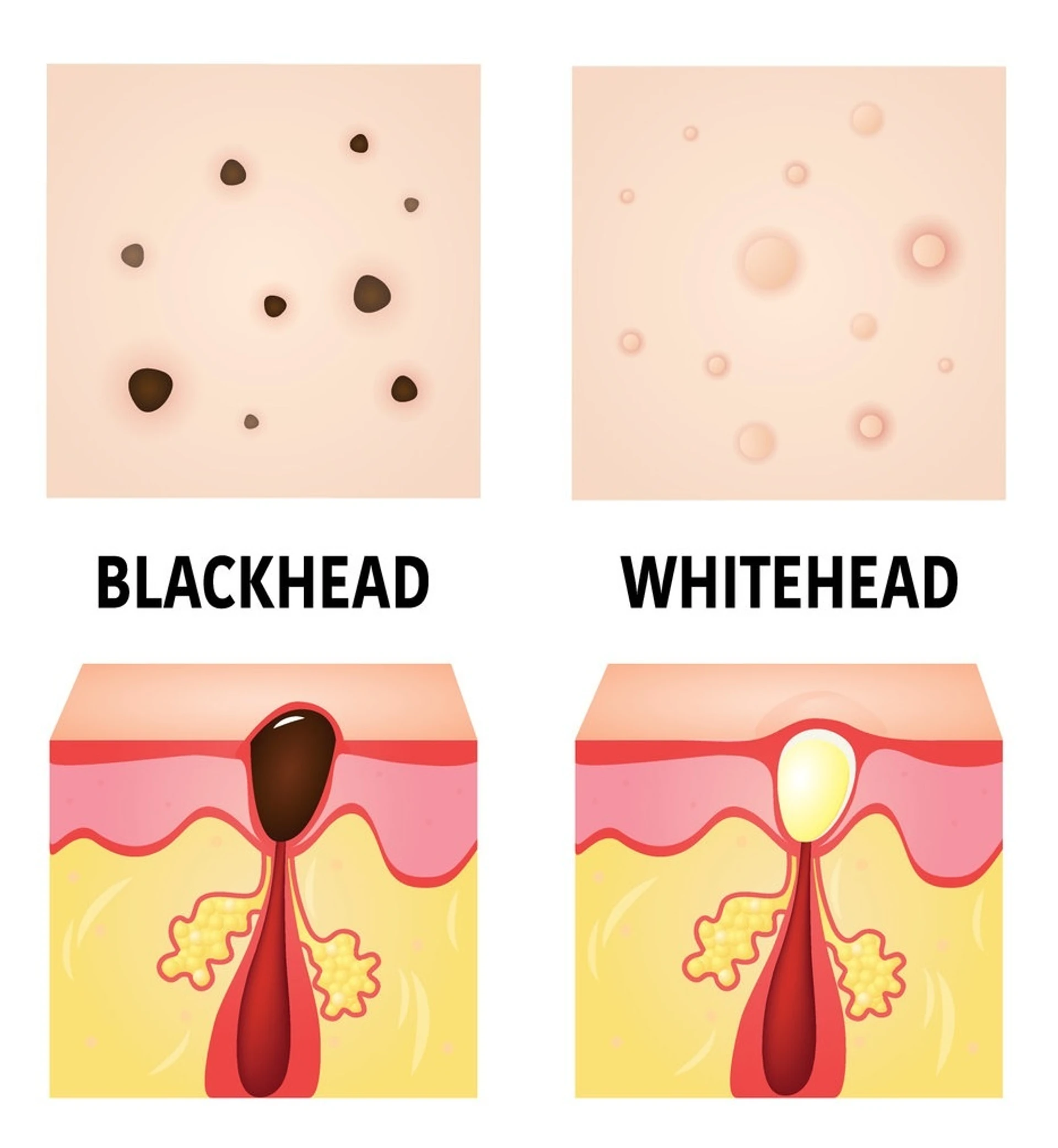 Komedonlar: açık ve kapalı