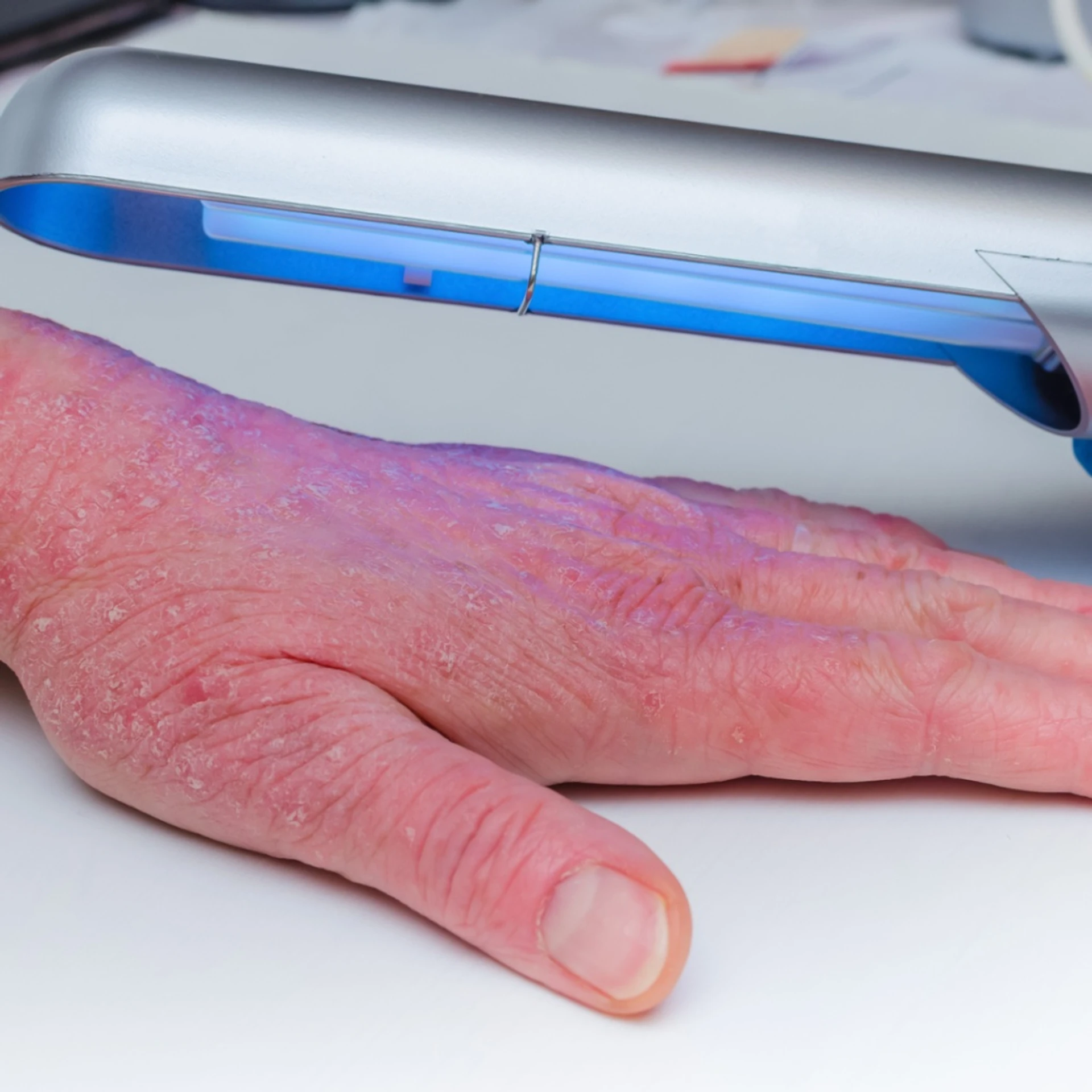 Kronik el egzamasının tedavisi için alternatif yaklaşımlar