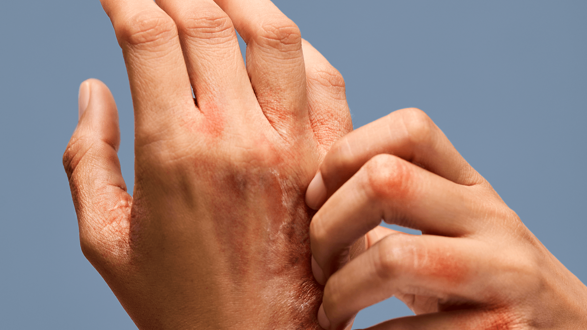 Kronik el egzamasının tedavisi için alternatif yaklaşımlar