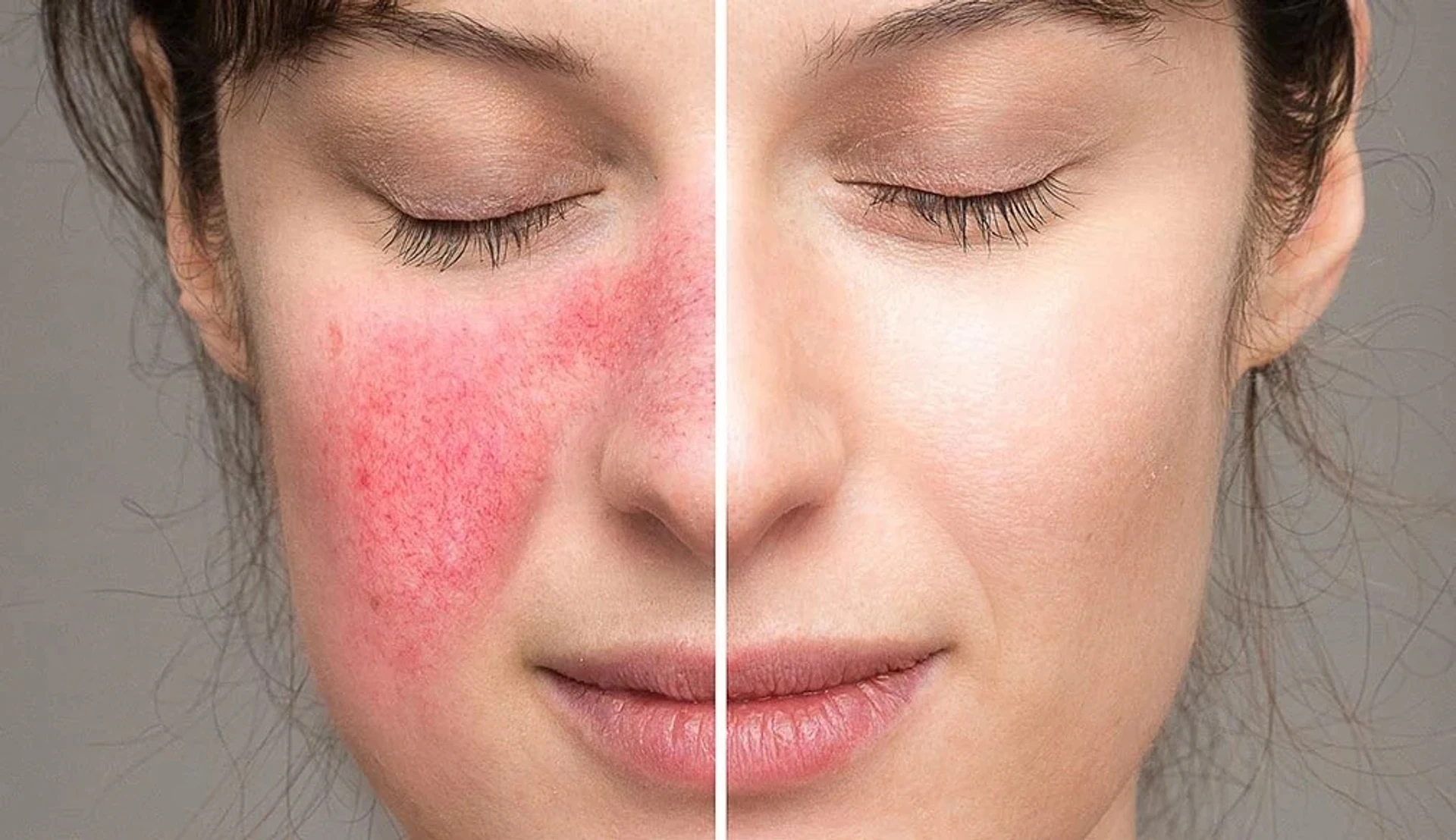 Rosacea tedavisinde probiyotiklerin faydaları