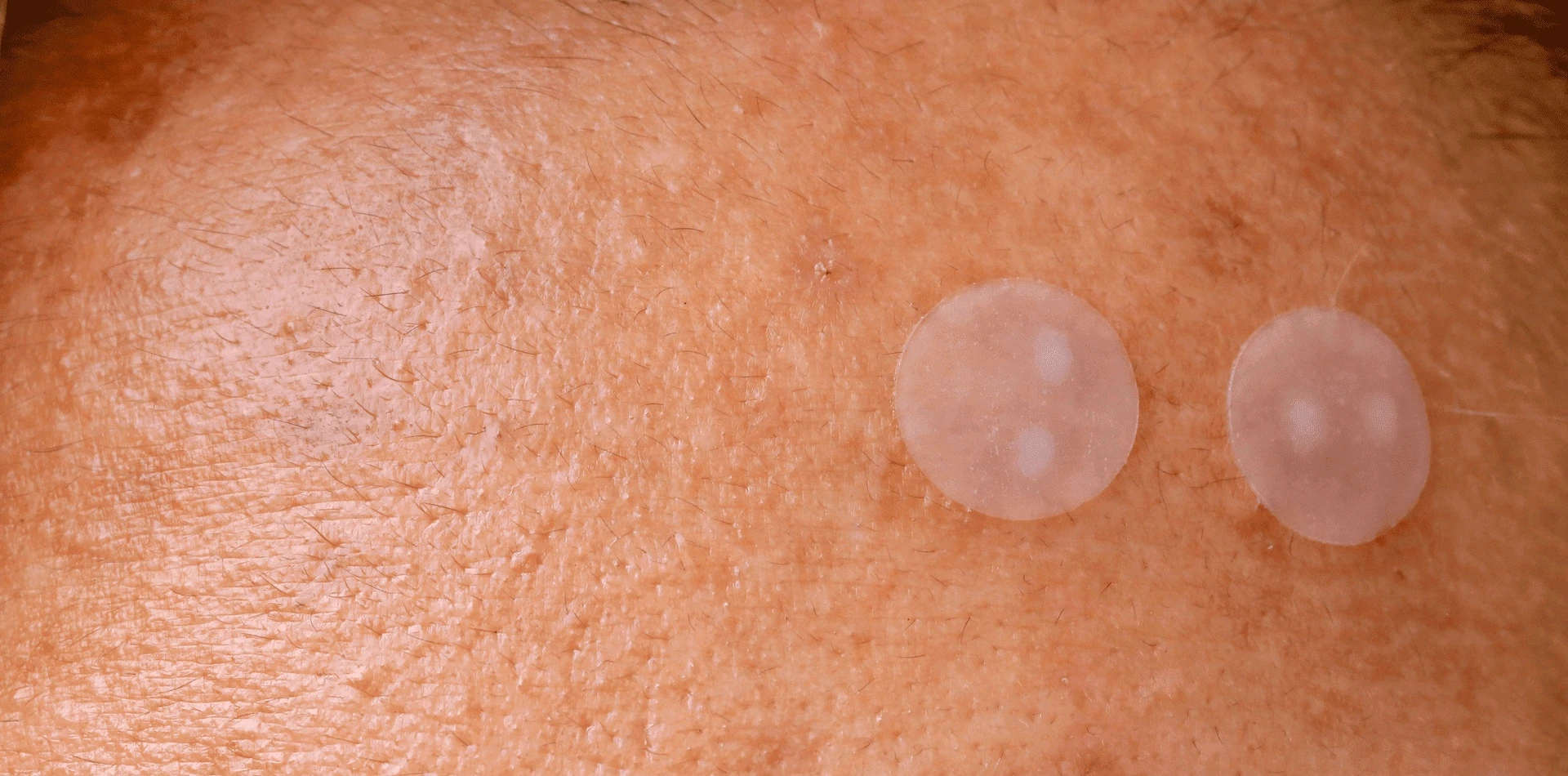 Sivilce bantları – akne bantları ne kadar etkili?