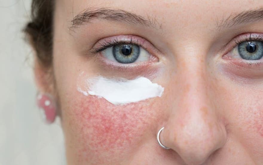 Azelaik Asidin Rosacea İçin Faydaları