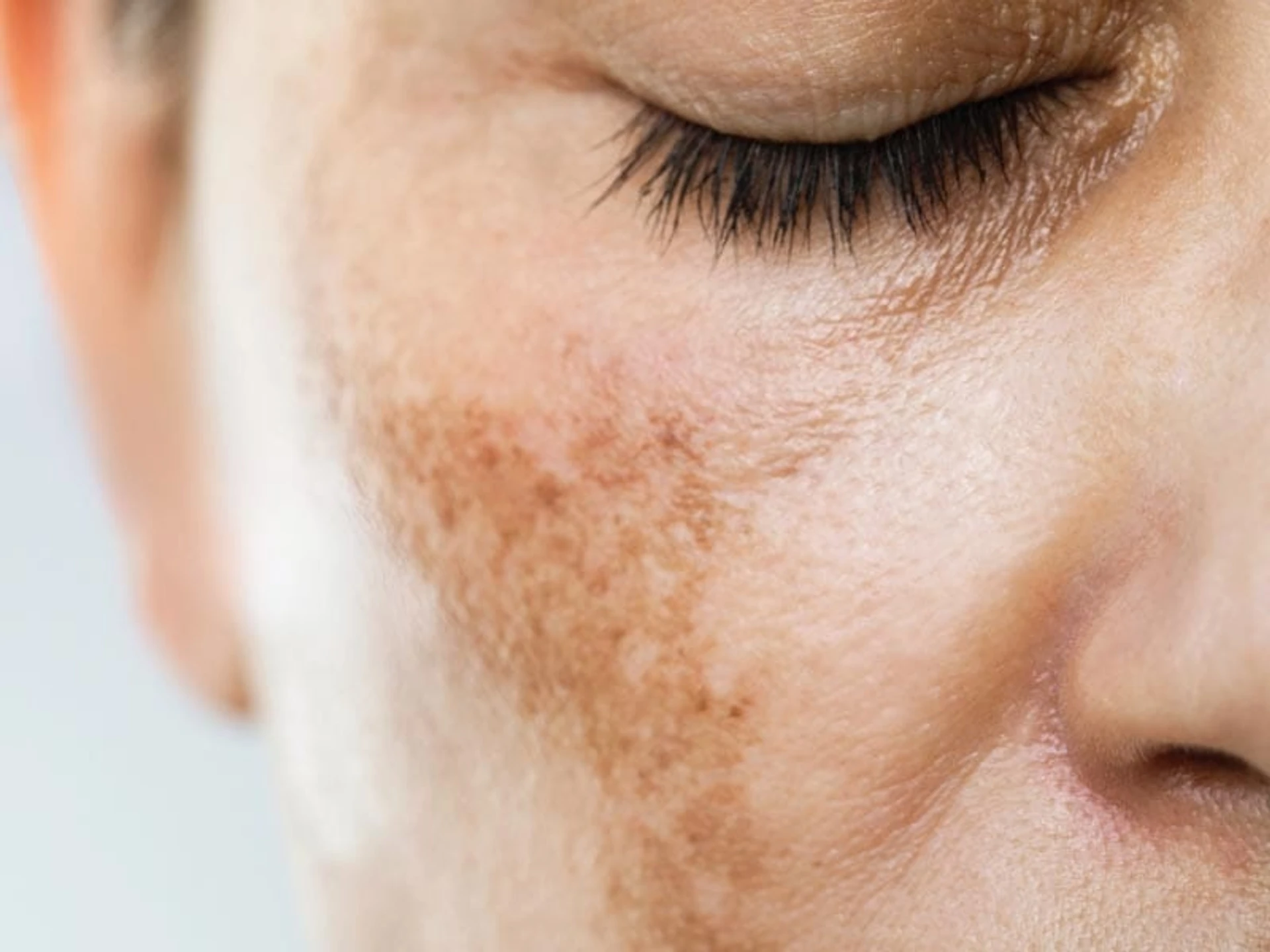 Pigmentasyonu azaltmak için en iyi 9 içerik