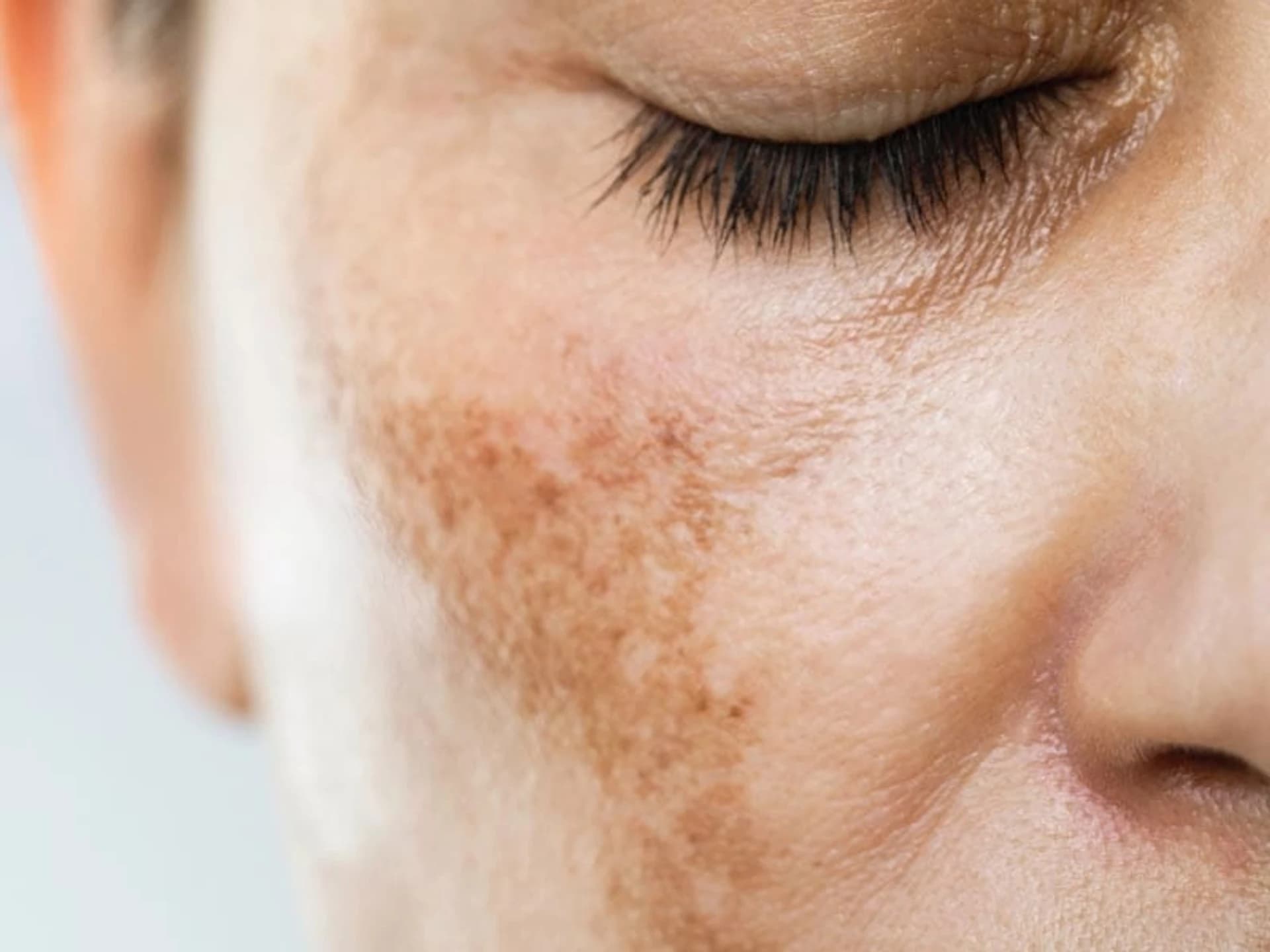 Pigmentasyonu azaltmak için en iyi 9 içerik