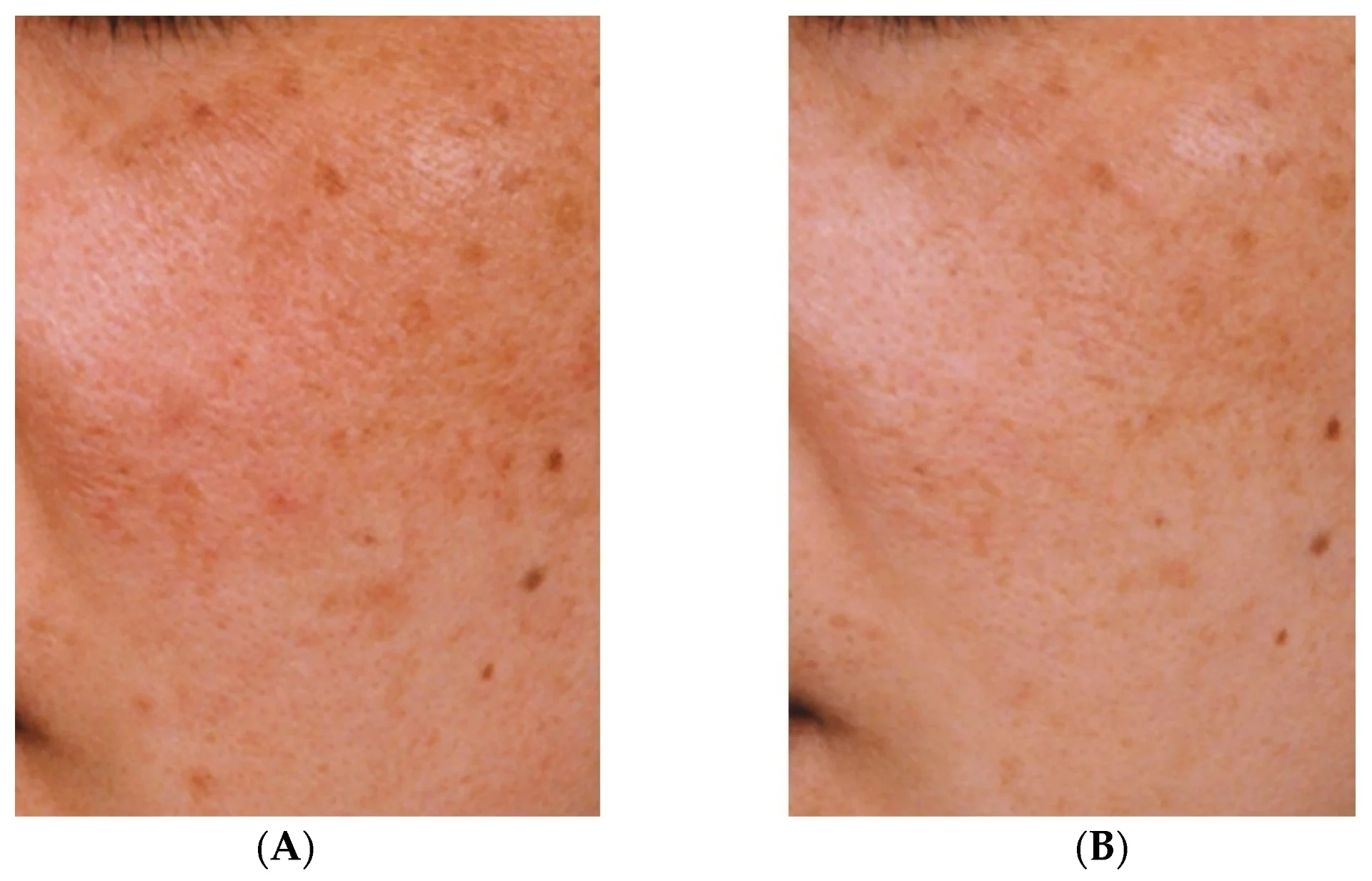 Melazma için traneksamik asit: faydaları ve yan etkileri