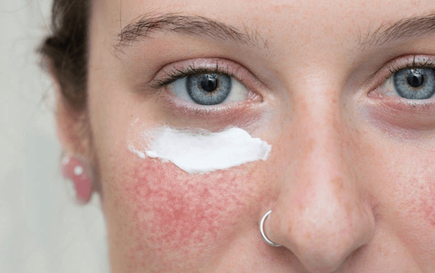 Azelaik Asidin Rosacea İçin Faydaları