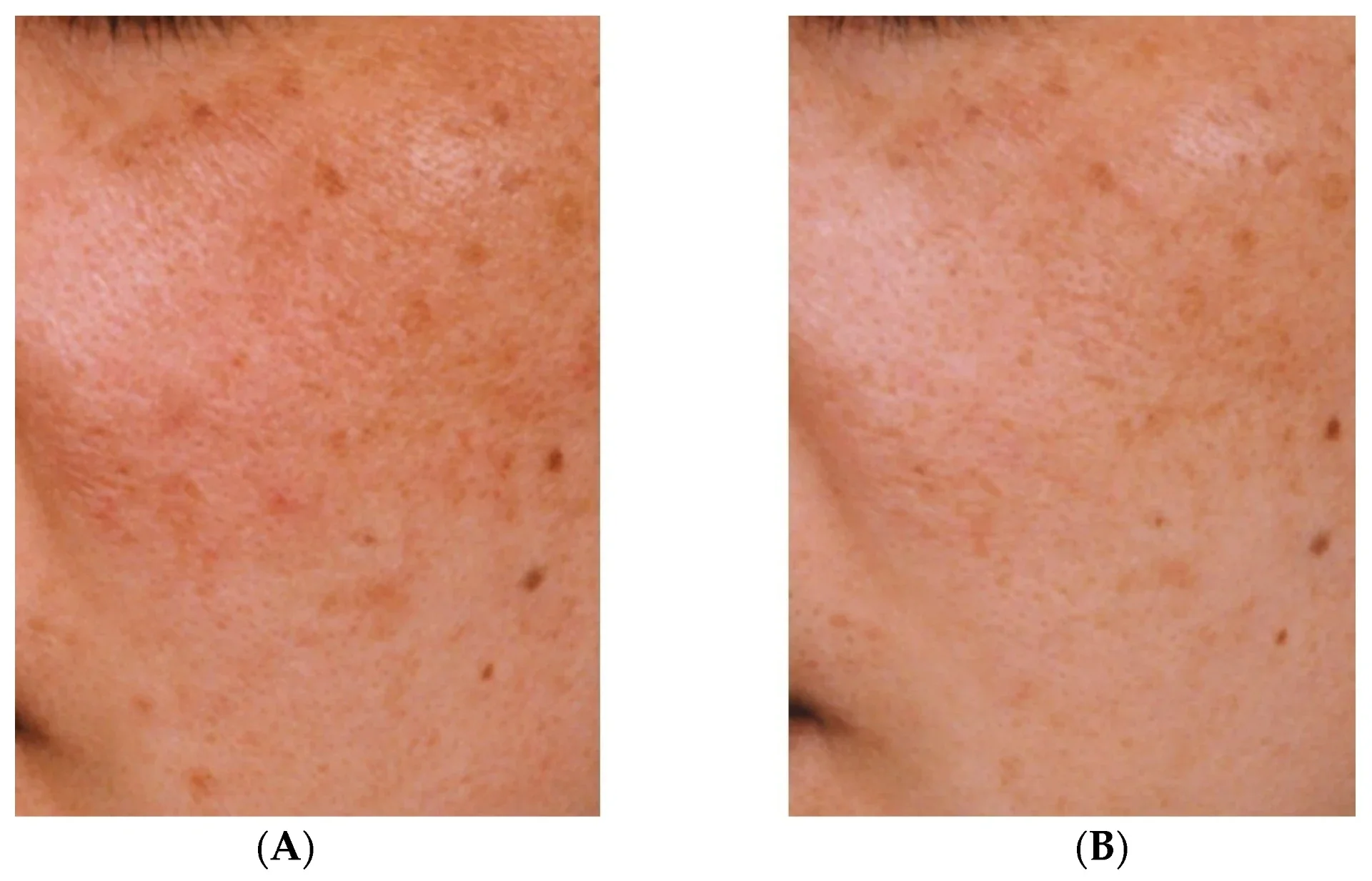 Melazma için traneksamik asit: faydaları ve yan etkileri